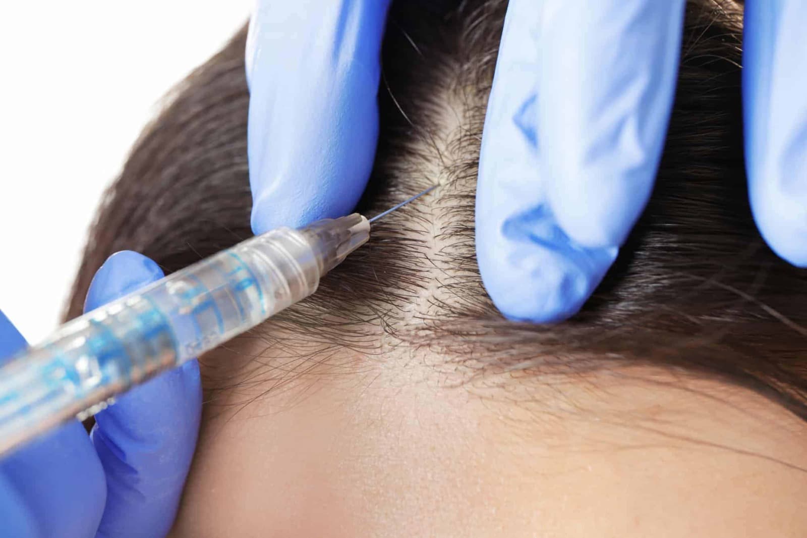 Hair Transplant Turkey: Discover the Best Clinics for 2025