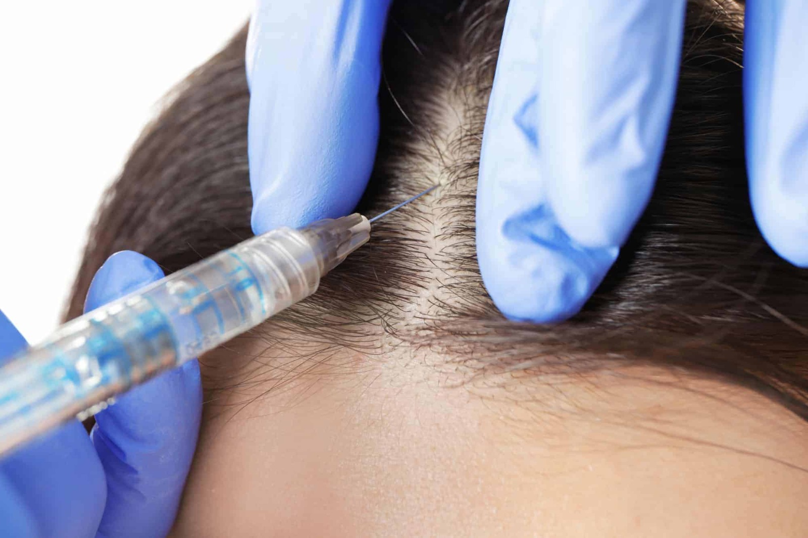 Hair Transplant Turkey: Discover the Best Clinics for 2025
