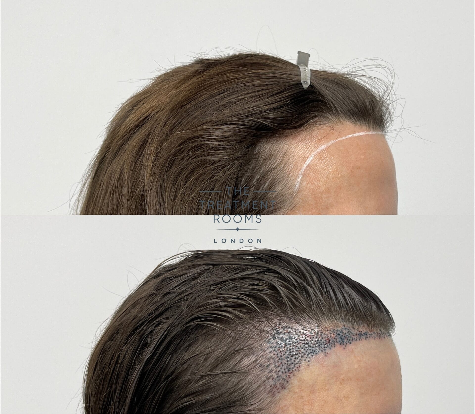 Leading Hair Transplant London Specialists – Book a Free Consultation