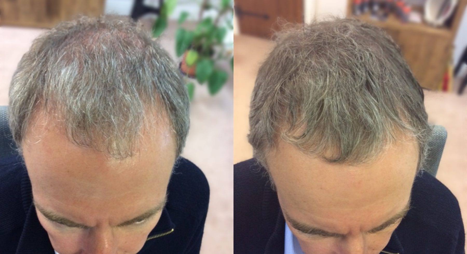 Hair Transplant London Before and After – See Real Patient Results